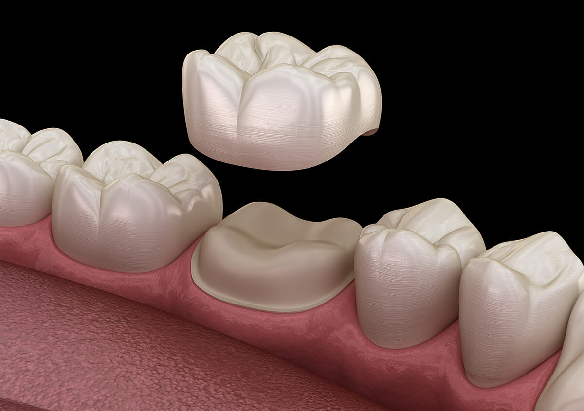 Types of Dental Crowns in Noblesville Area